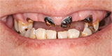 before dental implant treatment